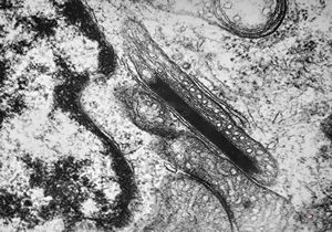 M,1y. | intramitochondrial inclusion - plexus papilloma